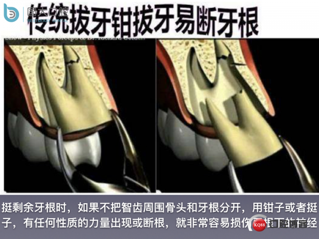 尹宽 余姚 左下8 智齿拔除 直立牙齿.016.jpeg