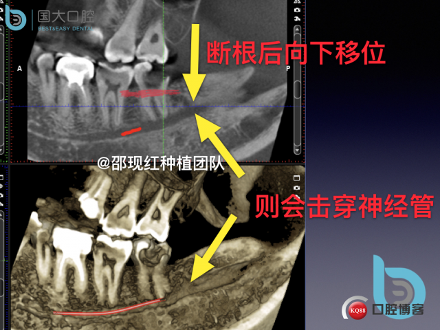 尹宽 余姚 左下8 智齿拔除 直立牙齿.017.jpeg