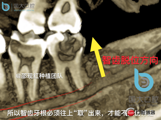 尹宽 余姚 左下8 智齿拔除 直立牙齿.018.jpeg