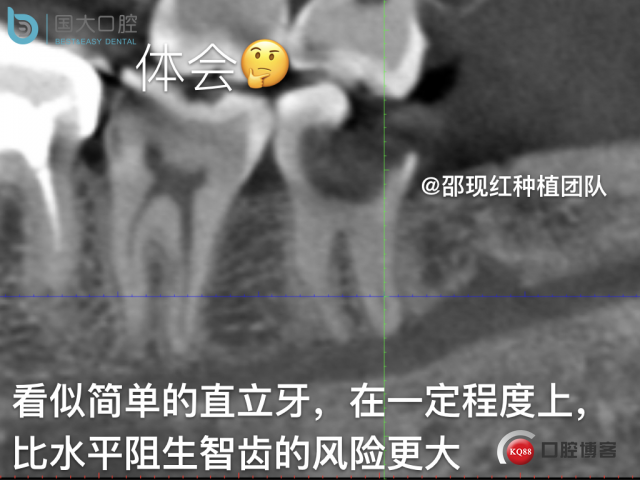 尹宽 余姚 左下8 智齿拔除 直立牙齿.019.jpeg