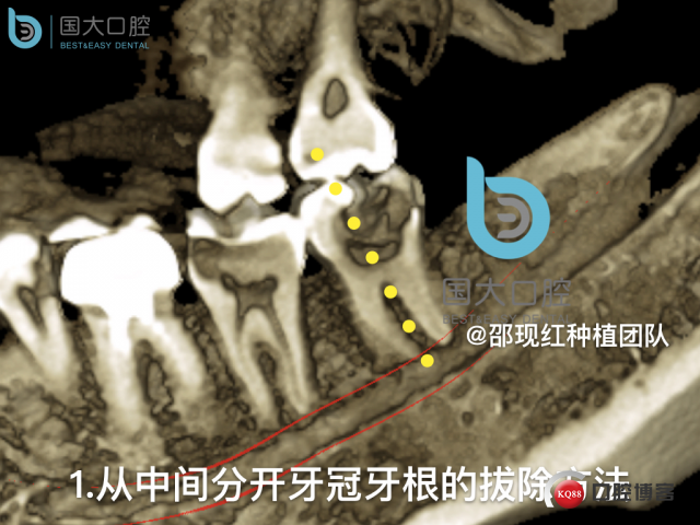 尹宽 余姚 左下8 智齿拔除 直立牙齿.022.jpeg