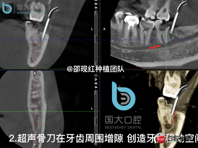 尹宽 余姚 左下8 智齿拔除 直立牙齿.024.jpeg