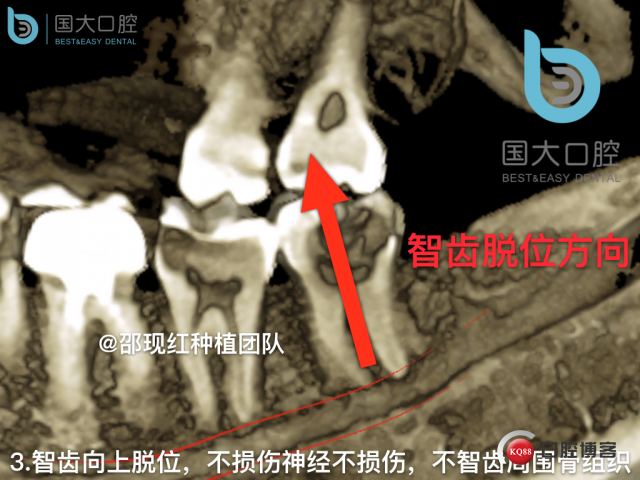 尹宽 余姚 左下8 智齿拔除 直立牙齿.025.jpeg