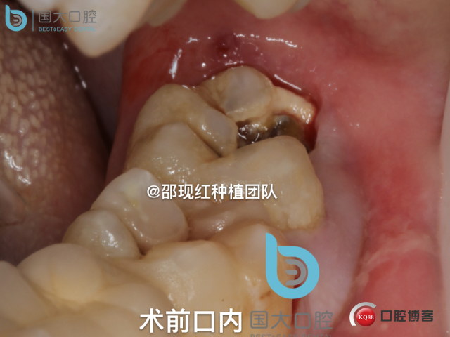 尹宽 余姚 左下8 智齿拔除 直立牙齿.026.jpeg