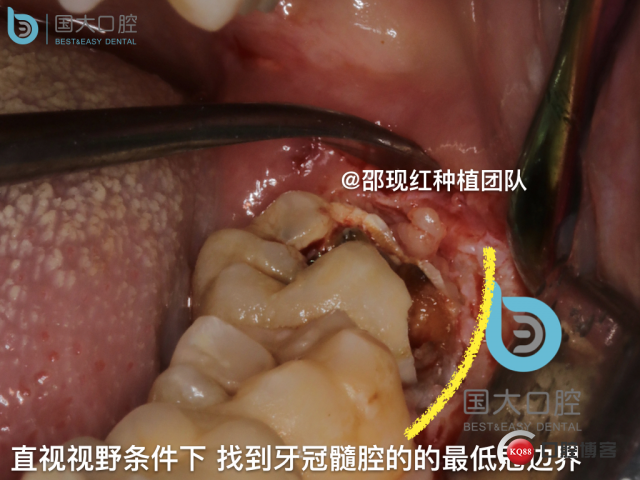 尹宽 余姚 左下8 智齿拔除 直立牙齿.028.jpeg
