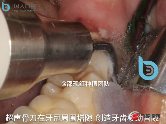 尹宽 余姚 左下8 智齿拔除 直立牙齿.029.jpeg