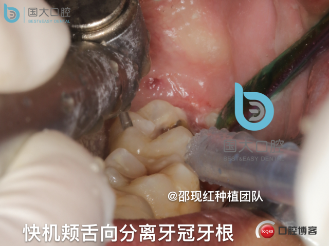 尹宽 余姚 左下8 智齿拔除 直立牙齿.031.jpeg