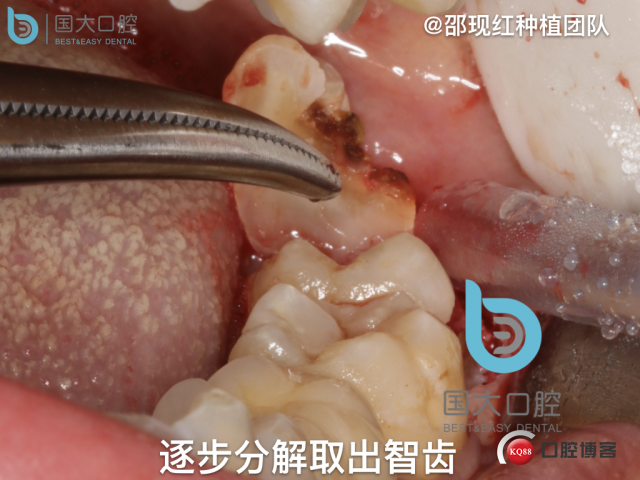 尹宽 余姚 左下8 智齿拔除 直立牙齿.032.jpeg
