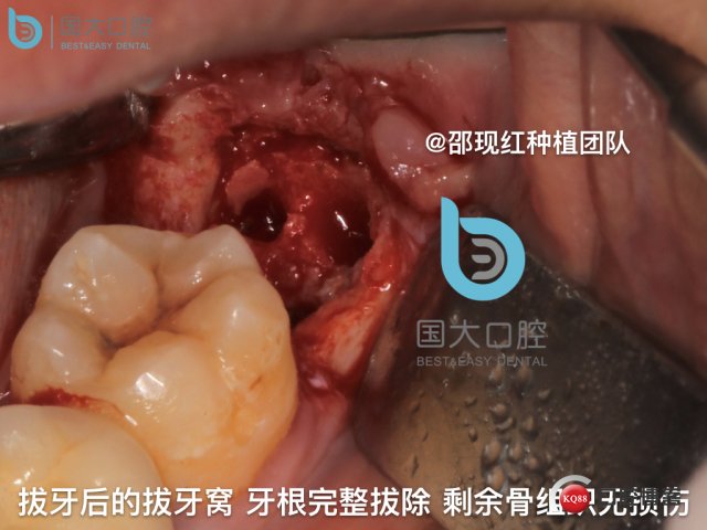 尹宽 余姚 左下8 智齿拔除 直立牙齿.034.jpeg