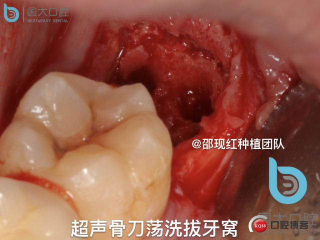 尹宽 余姚 左下8 智齿拔除 直立牙齿.035.jpeg