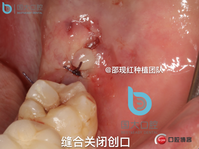 尹宽 余姚 左下8 智齿拔除 直立牙齿.037.jpeg