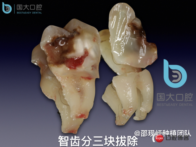 尹宽 余姚 左下8 智齿拔除 直立牙齿.038.jpeg