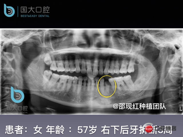 沈秋芳 左下4即刻种植 .003.jpeg
