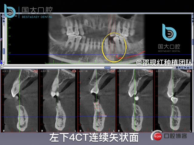 沈秋芳 左下4即刻种植 .005.jpeg