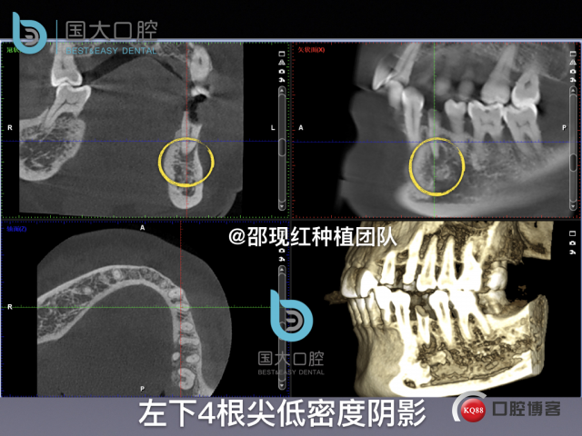 沈秋芳 左下4即刻种植 .006.jpeg
