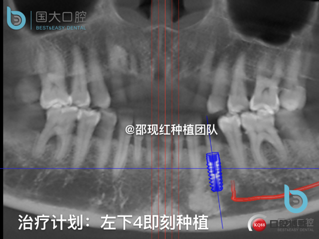 沈秋芳 左下4即刻种植 .008.jpeg