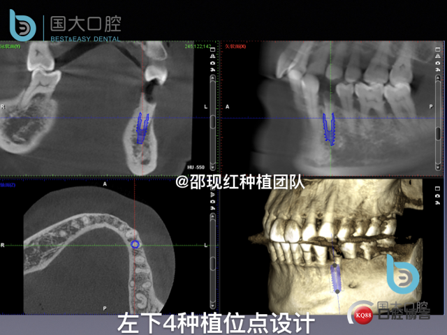 沈秋芳 左下4即刻种植 .009.jpeg