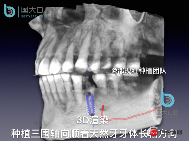 沈秋芳 左下4即刻种植 .011.jpeg