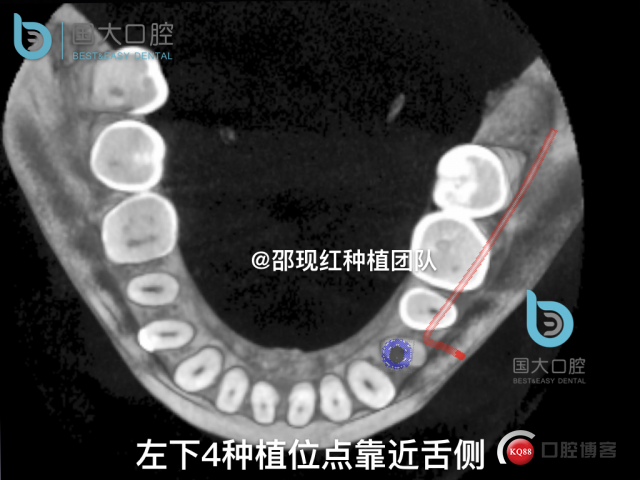 沈秋芳 左下4即刻种植 .012.jpeg