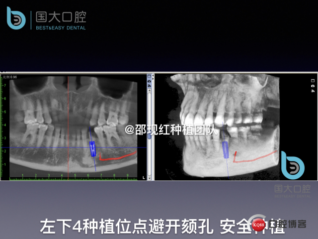 沈秋芳 左下4即刻种植 .013.jpeg