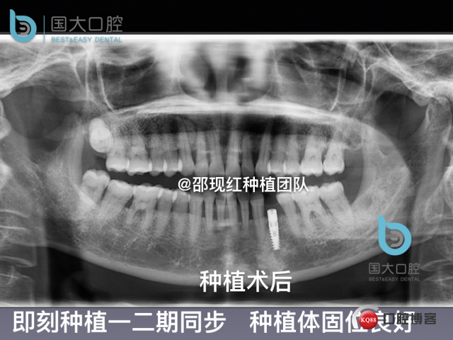 沈秋芳 左下4即刻种植 .026.jpeg