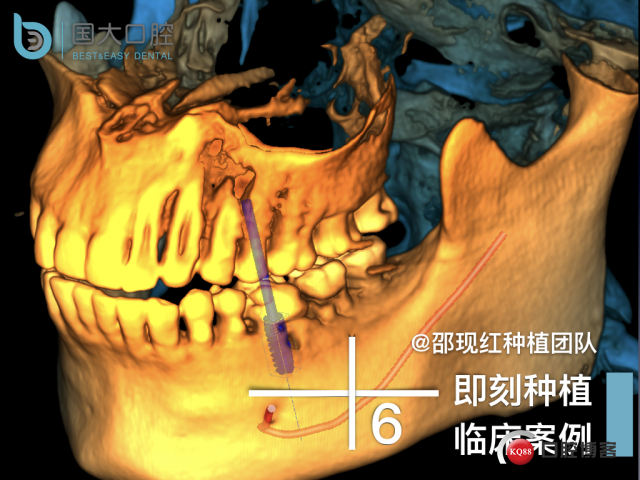 来澜 左下6标准即刻种植 sic 瘘管.001.jpeg