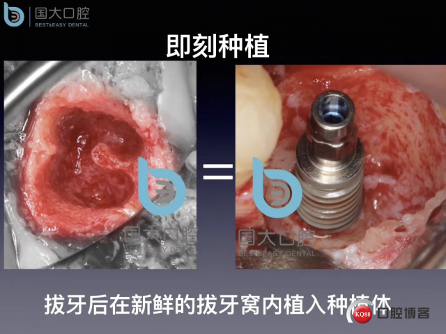 来澜 左下6标准即刻种植 sic 瘘管.002.jpeg
