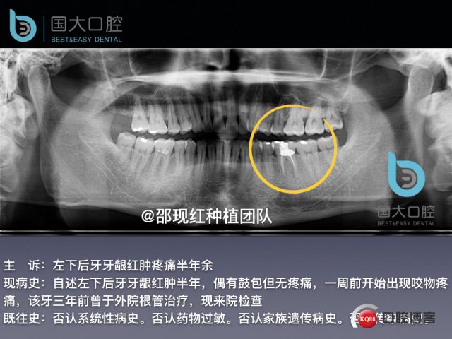 来澜 左下6标准即刻种植 sic 瘘管.003.jpeg