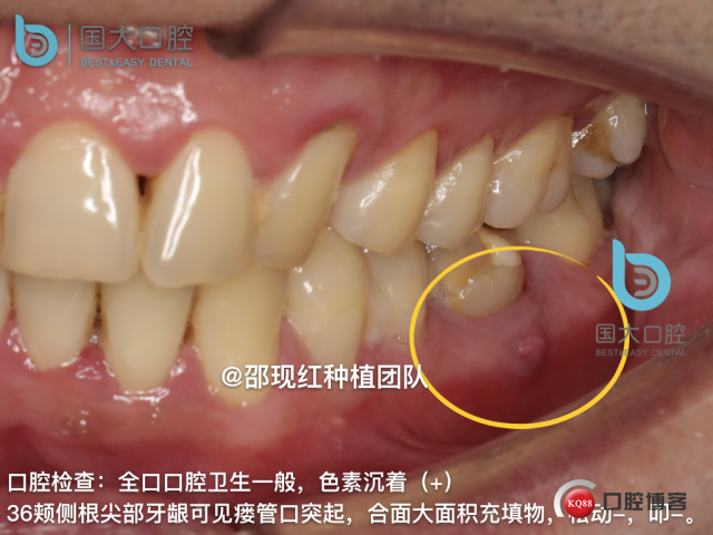 来澜 左下6标准即刻种植 sic 瘘管.007.jpeg