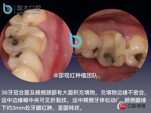 来澜 左下6标准即刻种植 sic 瘘管.008.jpeg
