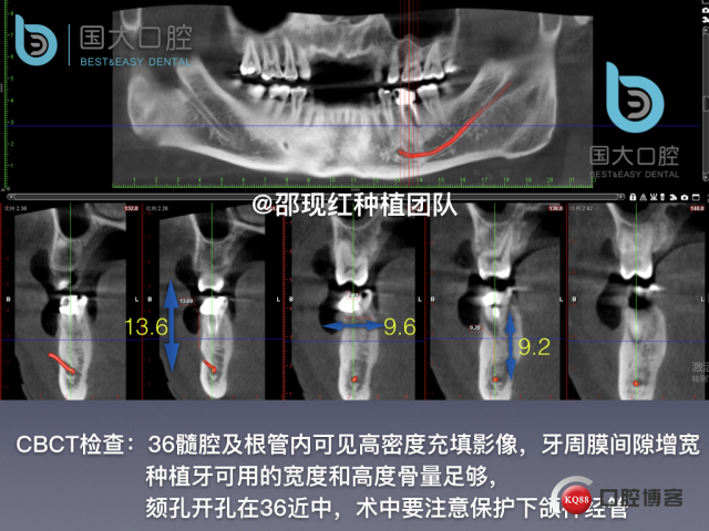 来澜 左下6标准即刻种植 sic 瘘管.009.jpeg