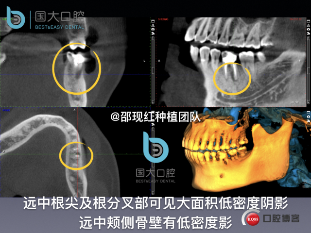 来澜 左下6标准即刻种植 sic 瘘管.010.jpeg