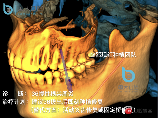 来澜 左下6标准即刻种植 sic 瘘管.011.jpeg