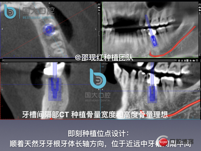 来澜 左下6标准即刻种植 sic 瘘管.012.jpeg