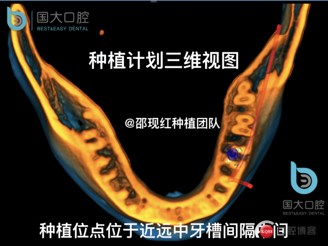 来澜 左下6标准即刻种植 sic 瘘管.013.jpeg