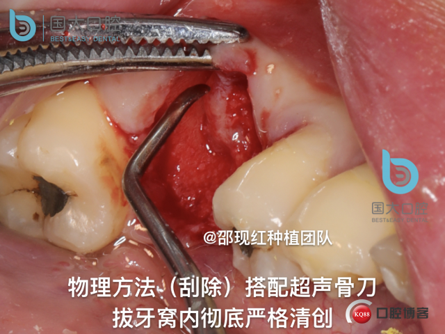 来澜 左下6标准即刻种植 sic 瘘管.015.jpeg