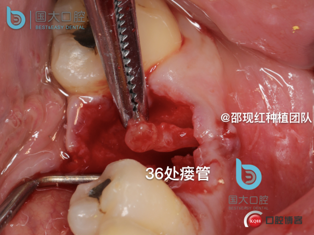 来澜 左下6标准即刻种植 sic 瘘管.016.jpeg