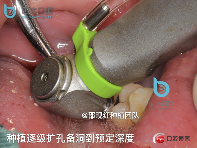 来澜 左下6标准即刻种植 sic 瘘管.017.jpeg