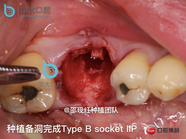 来澜 左下6标准即刻种植 sic 瘘管.018.jpeg