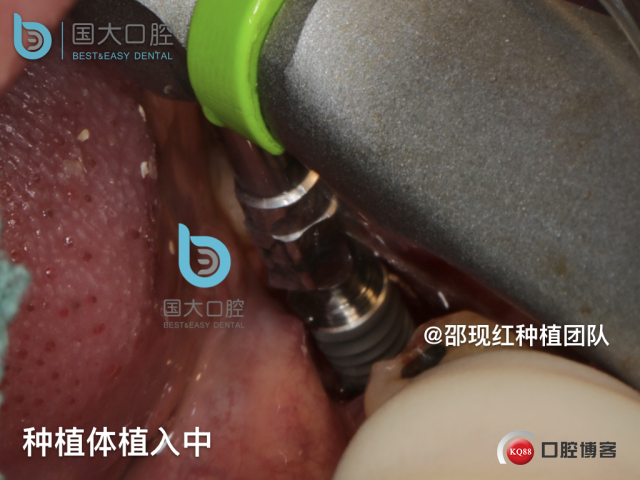 来澜 左下6标准即刻种植 sic 瘘管.019.jpeg