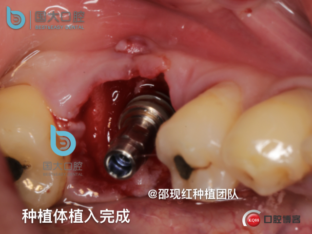 来澜 左下6标准即刻种植 sic 瘘管.020.jpeg