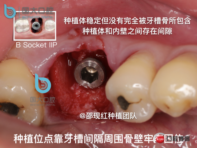 来澜 左下6标准即刻种植 sic 瘘管.021.jpeg