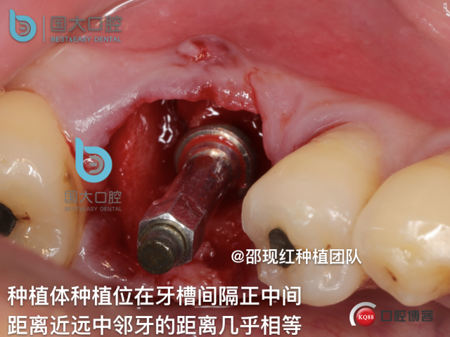 来澜 左下6标准即刻种植 sic 瘘管.022.jpeg