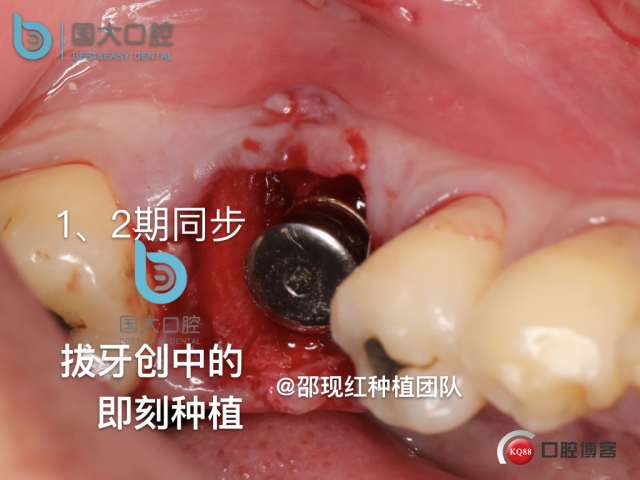 来澜 左下6标准即刻种植 sic 瘘管.023.jpeg