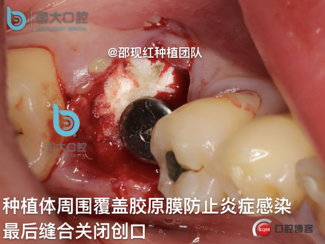 来澜 左下6标准即刻种植 sic 瘘管.024.jpeg