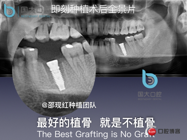 来澜 左下6标准即刻种植 sic 瘘管.026.jpeg