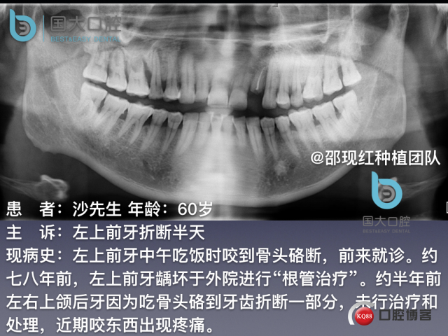 沙迪明 左上1即刻种植 牙片保留术.002.jpeg