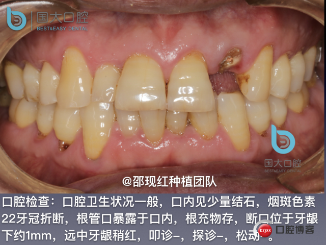 沙迪明 左上1即刻种植 牙片保留术.003.jpeg