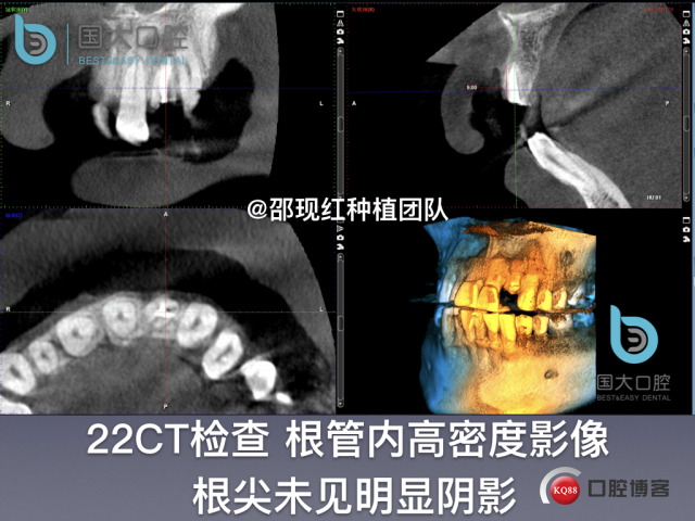 沙迪明 左上1即刻种植 牙片保留术.005.jpeg