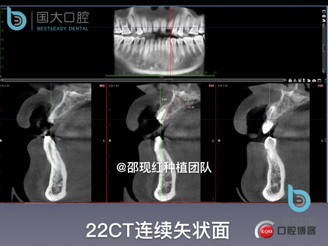沙迪明 左上1即刻种植 牙片保留术.006.jpeg